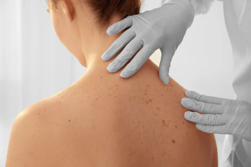 Dermatóloga revisando lunares en la espalda de una paciente